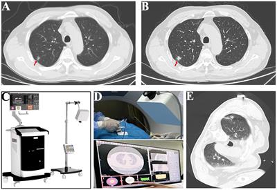 Computed tomography guided electromagnetic navigation system in percutaneous laser ablation for treating primary lung cancer: a case report